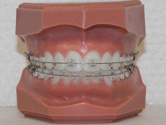 BracketsKeramikSelbstligierend2_291__1_-1920w.jpg